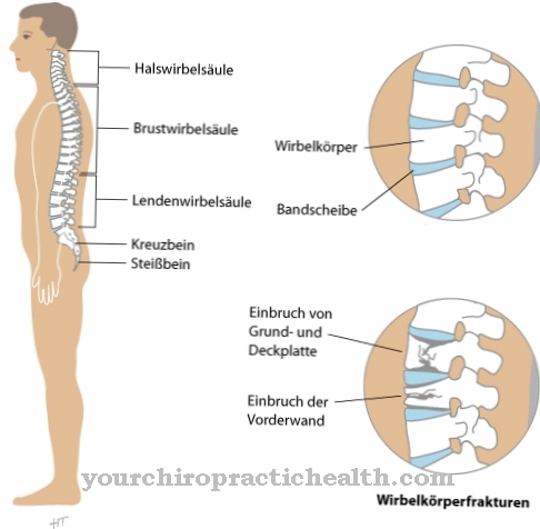 Фрактура на гръбначния стълб (фрактура на тялото на прешлените)