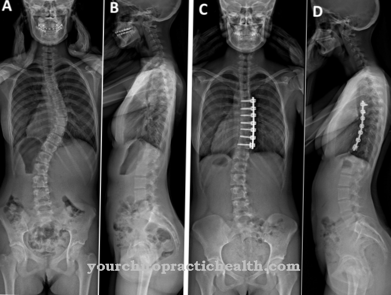 Spinal curvature