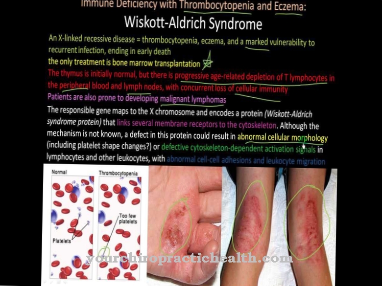 Wiskott-Aldrichův syndrom