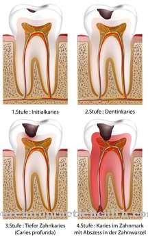 Tooth damage