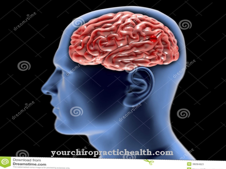 تمدد الأوعية الدموية الدماغية