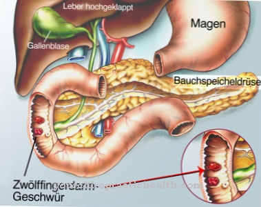 Úlcera duodenal