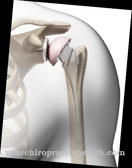 Shoulder prosthesis