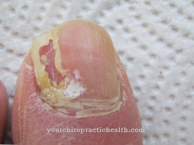 Effectively prevent nail fungus