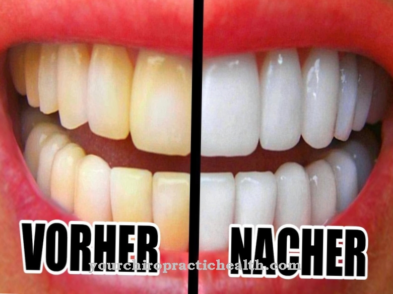 Dents blanches éclatantes: quand le blanchiment a-t-il un sens?