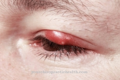 Inflammation of the eyes