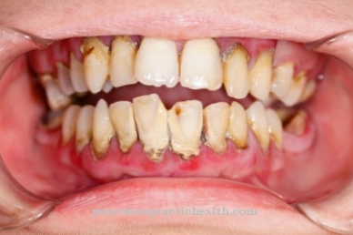 Dents jaunes (décoloration des dents)