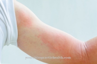 Symptoms - Skin rash (exanthema)