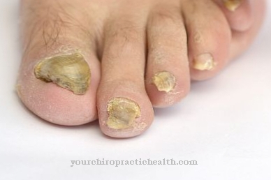 Nail dystrophy