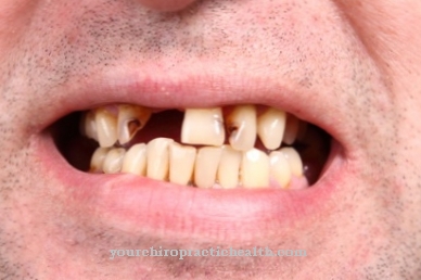 Simptomi - Gubitak zuba